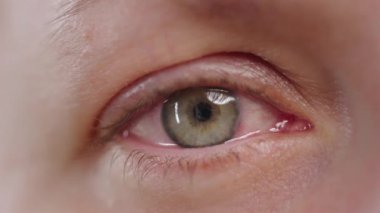 Konjonktivitten, gripten, soğuk algınlığından ya da alerjiden etkilenen bir kadının kırmızı gözünü kapat. Sağlık, hastalık ve tedavi kavramı.