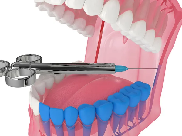 人間の顎の3Dレンダリング下側の肺胞神経ブロック技術 歯科麻酔技術の概念 — ストック写真