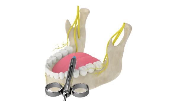Mandibulární Oblouk Podřadným Alveolárním Nervovým Blokem Typy Zubní Anestezie Koncept — Stock video