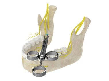 Alt alveolar sinir bloğuyla 3 boyutlu çene kemeri. Diş anestezi konsepti. 
