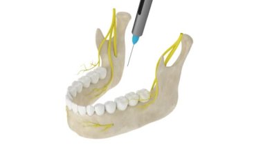 Kesik sinir bloklu çene kemeri. Diş anestezi konsepti. 