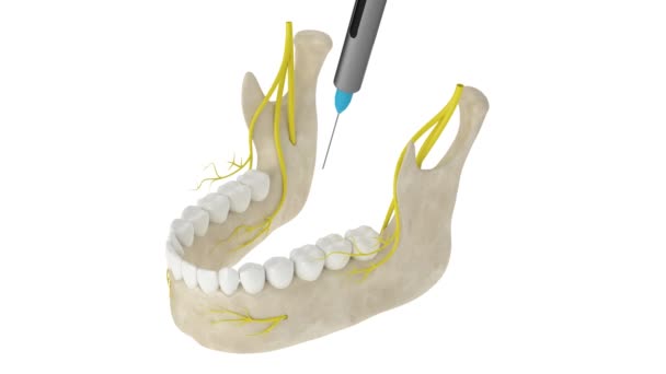 Mandibular Arch Incisive Nerve Block Types Dental Anesthesia Concept — Stock Video