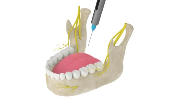 Mandibulární Oblouk Řezným Nervovým Blokem Typy Zubní Anestezie Koncept — Stock video