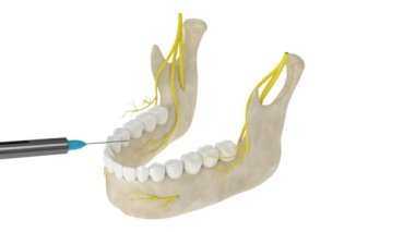 Çene kemeri ve sinir bloğu. Diş anestezi konsepti. 