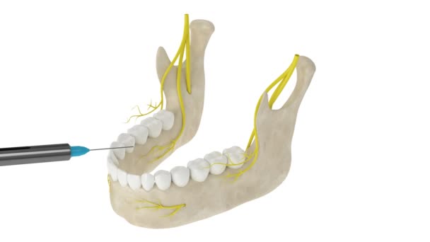 Mandibulární Oblouk Bukálním Nervovým Blokem Typy Zubní Anestezie Koncept — Stock video