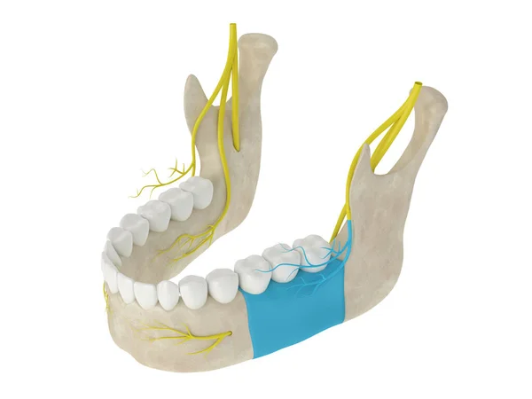 Arco Mandibular Con Bloqueo Nervios Bucales Tipos Concepto Anestesia Dental — Foto de Stock