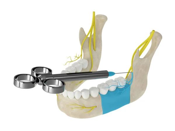 Mandibular Arch Buccal Nerve Block Types Dental Anesthesia Concept — Stock Photo, Image