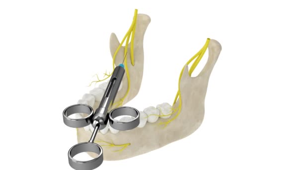 下颌骨拱门神经阻滞 牙科麻醉概念的类型 — 图库视频影像