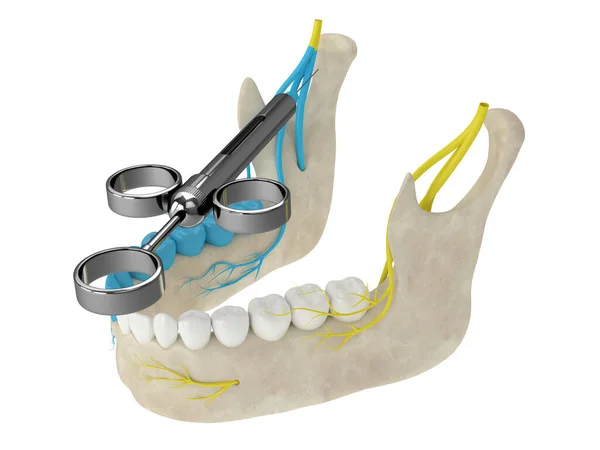 Render Mandibular Arch Gow Gates Nerve Block Types Dental Anesthesia — Stock Photo, Image