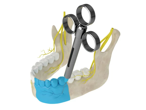 Mandibular Arch Incisive Nerve Block Types Dental Anesthesia Concept — Stock Photo, Image