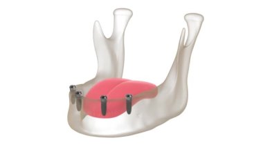 Çıkarılabilir takma dişler eklentisi, implantlar tarafından desteklenmektedir