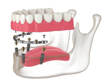 3d render of bar retained removable overdenture installation supported by implants over white clipart