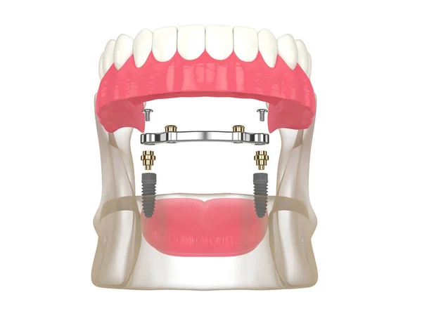 Render Bar Retained Removable Overdenture Installation Supported Two Implants White — Stock Photo, Image