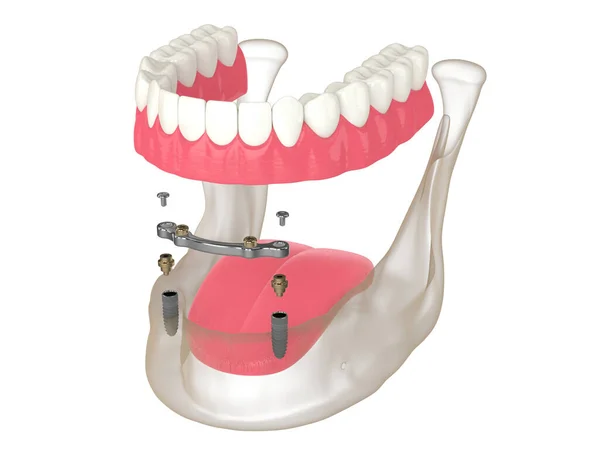 Render Bar Retained Removable Overdenture Installation Supported Two Implants White — Zdjęcie stockowe