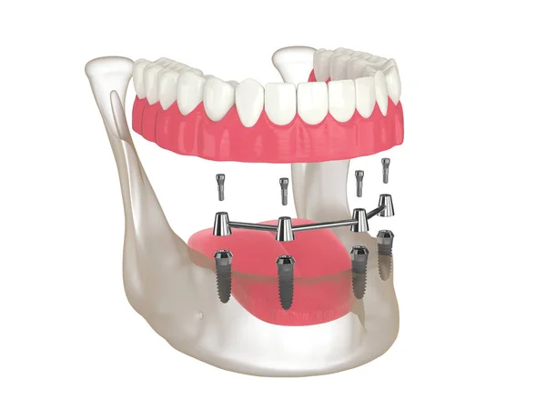 Render Bar Retained Removable Overdenture Installation Supported Four Implants White — Stock Photo, Image