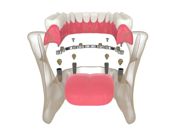 Render Bar Retained Removable Overdenture Installation Supported Implants White — Zdjęcie stockowe