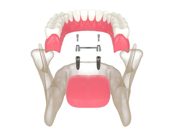 Render Removable Overdenture Installation Bar Clip Attachment Supported Implants — Stock Photo, Image