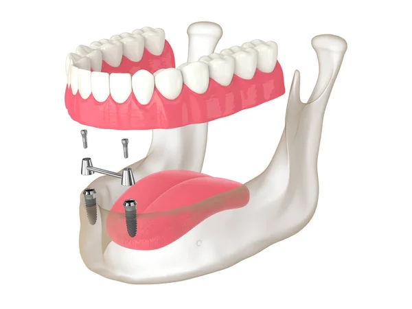 Render Removable Overdenture Installation Bar Clip Attachment Supported Implants — Stock fotografie