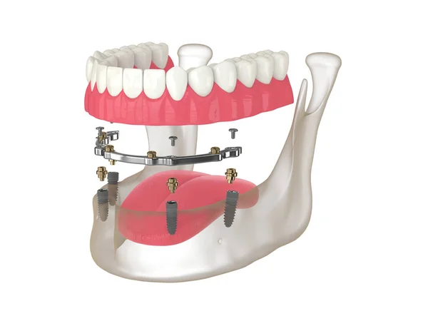 Render Bar Retained Removable Overdenture Installation Supported Implants White — Fotografie, imagine de stoc