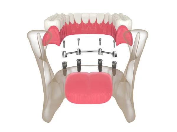 Render Bar Retained Removable Overdenture Installation Supported Four Implants White Stock Kép