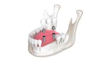 Dental bridge fixed to the mandible with two implants over white background