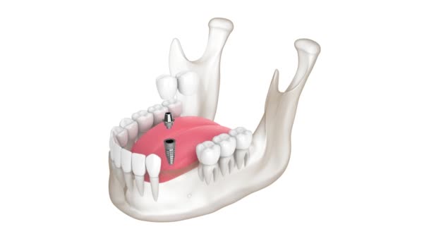 Mandible Implant Supported Dental Cantilever Bridge Isolated White Background — Stok video