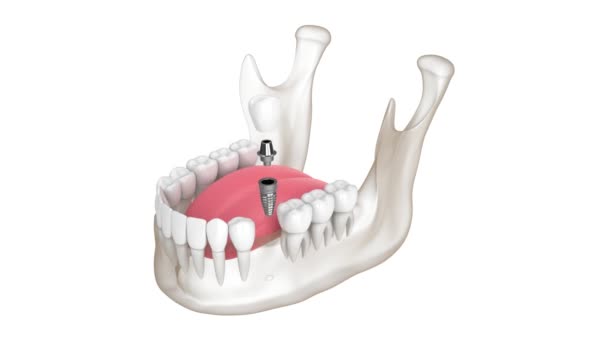 Mandible Dental Implant Placement Isolated White Background — Stok video