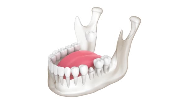 白い背景の上に歯の形をした歯冠を埋め込むことができます — ストック動画