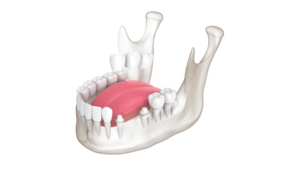 Mandible Dental Bridge Molar Premolar Teeth — Video Stock