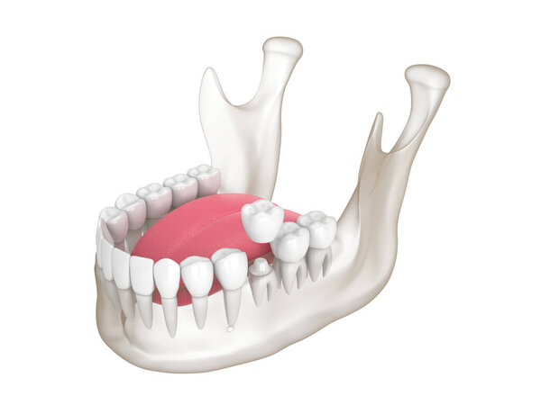 3d render of mandible with dental crown embed on reshaped tooth over white background
