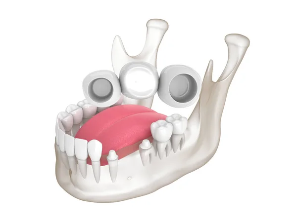 Render Mandible Dental Bridge Molar Premolar Teeth Rechtenvrije Stockafbeeldingen