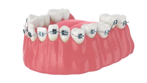 Zarovnání Zubů Podle Ortodontické Rovnátka Izolované Přes Bílé Pozadí — Stock video
