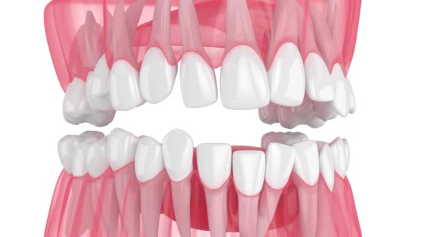 Çarpık Dişleri Olan Bir Insan Çenesi Ortodontik Tedavi Kavramı — Stok video
