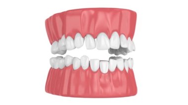 Human jaw with crooked teeth straightening. Orthodontic treatment concept. 
