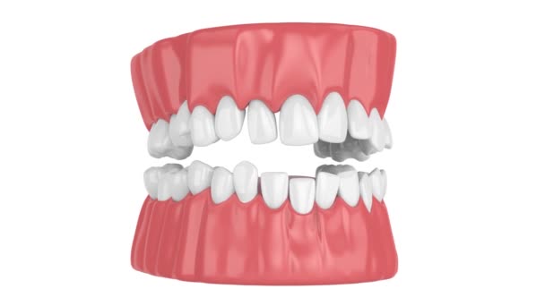 Çarpık Dişleri Olan Bir Insan Çenesi Ortodontik Tedavi Kavramı — Stok video