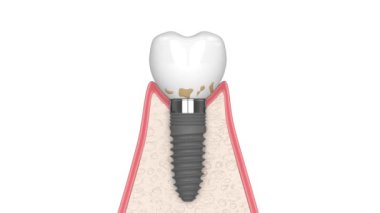 Beyaz arka plan üzerinde insan diş etleri ve peri implantı hastalığı.