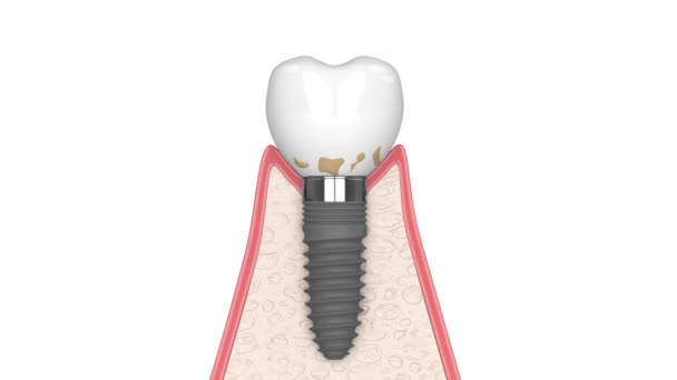 白い背景の上にPeri Implantitis病気と人間の歯茎の断面 — ストック動画