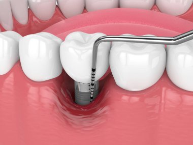 İnsan çenesinin 3 boyutlu görüntülemesi peri implanti hastalığı ve periodontal sonda ile yakın plan 