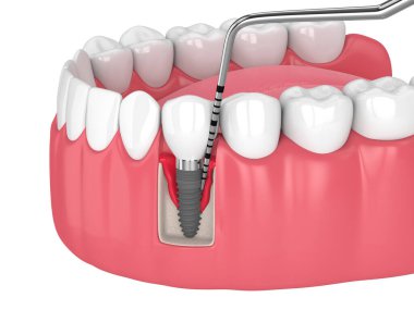 Perioimplantit hastalığı ve periodontal sonda ile insan çenesinin beyaz arkaplan üzerinde 3D görüntülenmesi