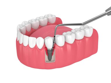 Perioimplantit hastalığı ve periodontal sonda ile insan çenesinin beyaz arkaplan üzerinde 3D görüntülenmesi