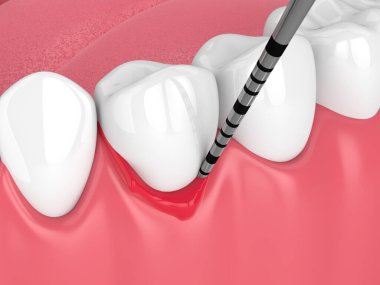 3d render of human jaw with peri implantitis disease and periodontal sonda clipart