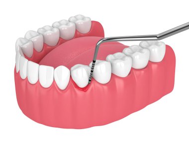 Perioimplantit hastalığı ve periodontal sonda ile insan çenesinin beyaz arkaplan üzerinde 3D görüntülenmesi