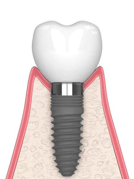 Render Gum Cross Secton Implant Placement White Background ஸ்டாக் புகைப்படம்
