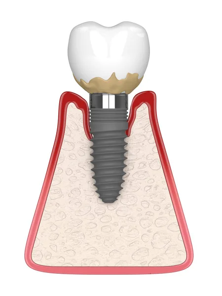 Renderen Van Menselijke Tandvlees Doorsnede Met Peri Implantitis Ziekte Witte Stockfoto
