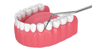 Peri implanti hastalığı ve periodontal sondası olan alt çene.