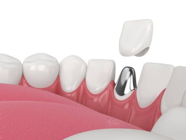 Beyaz arkaplan üzerinde döküm post ve çekirdek diş restorasyonu ile alt çene 3d oluşturma