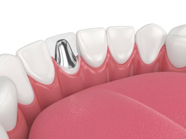 Beyaz arkaplan üzerinde döküm post ve çekirdek diş restorasyonu ile alt çene 3d oluşturma