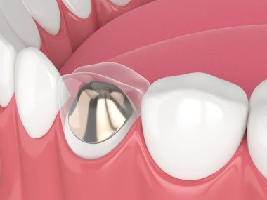 Beyaz arkaplan üzerinde döküm post ve çekirdek diş restorasyonu ile alt çene 3d oluşturma