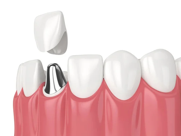 3Dレンダリングの下顎キャストポストとコア歯の復元白の背景に — ストック写真