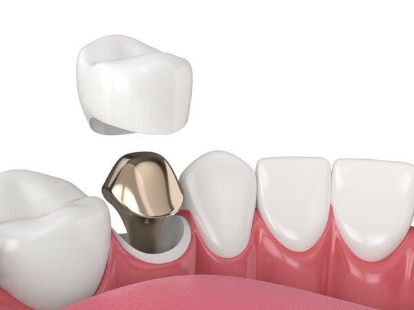 3d render of lower jaw with cast post and core tooth restoration over white background